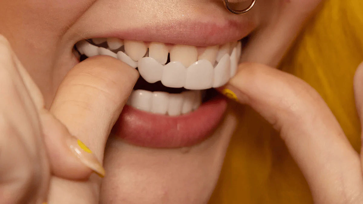 Instant Pop On Veneers (with Impression Kit)