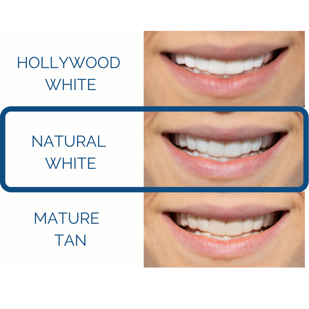 Instant Pop On Veneers (with Impression Kit)
